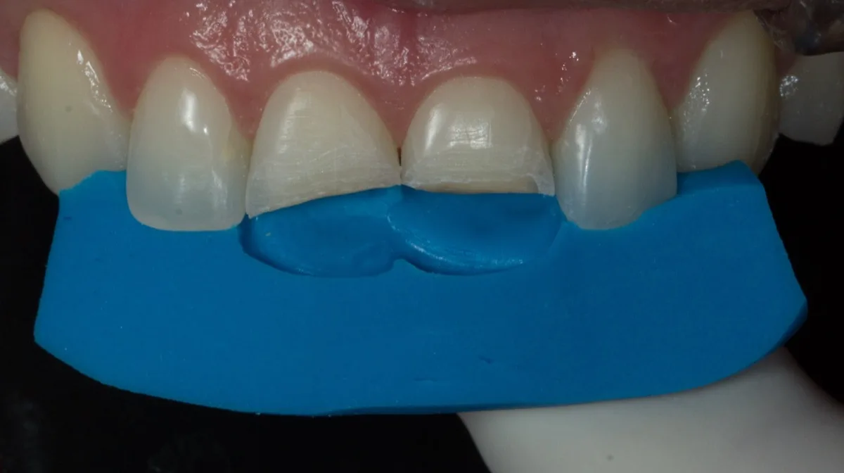 Resinas antigas removidas com matriz de silicone posicionada