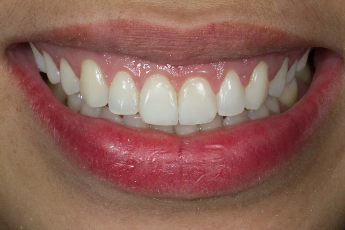 Sorriso final da paciente